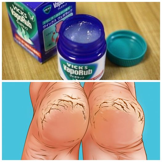 Codziennie wieczorem nacierała stopy Vicks Vaporub. Efekt Cię zachwyci